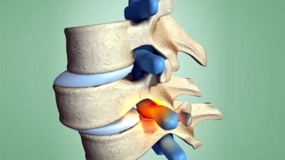 Bel Kayması (Spondilolistezis)