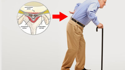 Kanal Daralması (Spinal Stenoz)