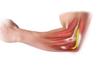 Kubital Tünel Sendromu (Ulnar Oluk Sendromu)