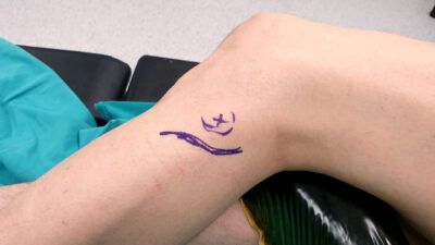 Peroneal Sinir Tuzaklanması