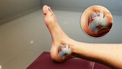 Tarsal Tünel Sendromu